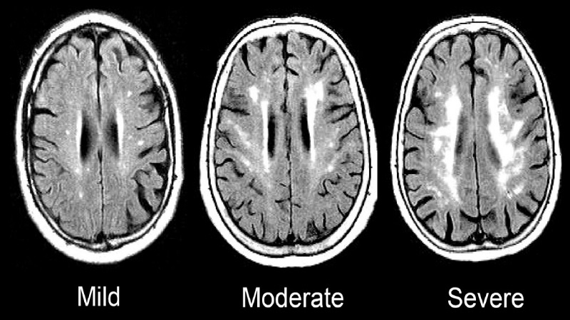 mid-to-late-life-increases-in-marker-of-chronic-inflammation-tied-to